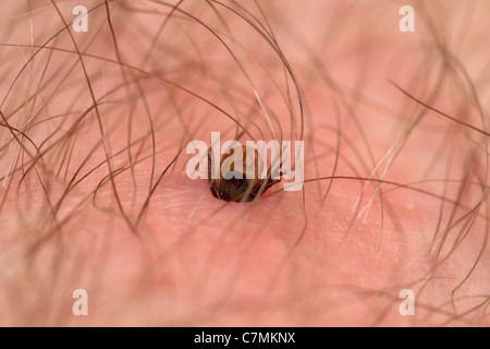 European castor bean tick - Sheep tick, Ixodes ricinus, feeding on human skin Stock Photo