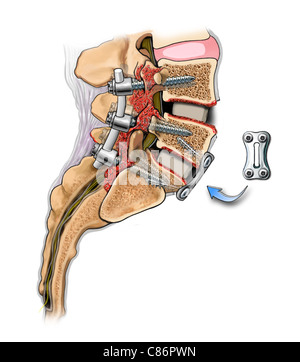 Lumbar Bone Fusion of L4-S1 Stock Photo, Royalty Free Image: 39487662 ...