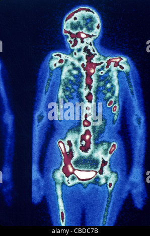 Nuclear medical bone scan, multiple focal metastatic lesions on lungs Stock Photo