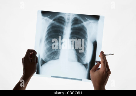 Hands holding a chest x-ray and a cigarette, close-up Stock Photo