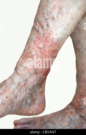 Elderly woman's legs suffering from eczema & varicose veins on a white background Stock Photo