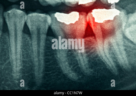 Dental xray with red painful area Stock Photo