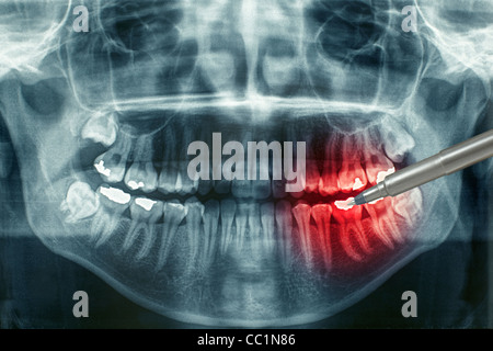 Dental xray with red painful area Stock Photo