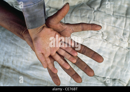 Hexadactyly ; Indian family with six fingers in hands ; congenital malformation ; Polydactyly ; polydactylism ;  hyperdactyly ; India ; Asia Stock Photo