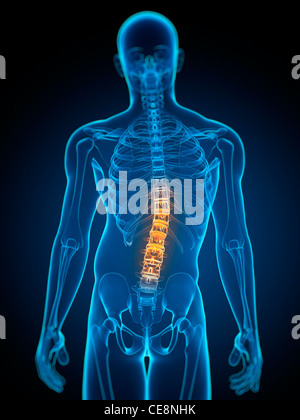 Scoliosis. Computer artwork of a man with a sideways curvature (scoliosis) of the spine. Stock Photo