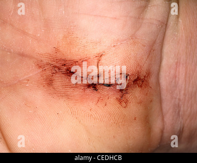 April 2008 - Close in near Macro of post operation scaring following an operation for Carpel Tunnel surgery Stock Photo