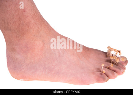 dirty infected foot mycosis on white background Stock Photo