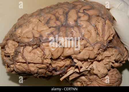 Original Human Brain specimen taken outside in a Beaker and doctor's hand with gloves on frame. Stock Photo