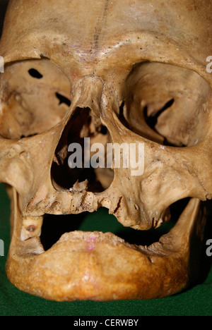 Original Human Skull of a Old Aged Person Preserved in a Medical college for Research and Study Purposes.Old Man Skull Closeup Stock Photo