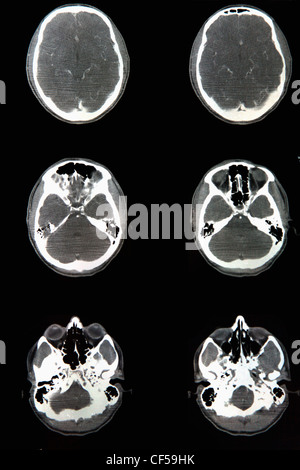 Ct scan report of head and skull, close up Stock Photo - Alamy
