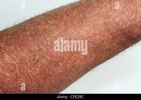 Sunburned Peeling Skin. Dead skin peeling due to overexposure in the sun about 12 days earlier. Caucasion male forearm shown. Stock Photo