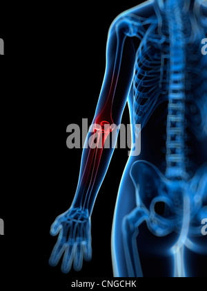 Elbow pain  conceptual artwork Stock Photo