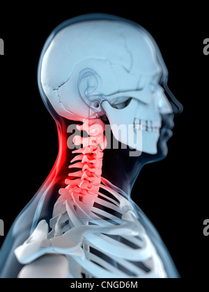 Neck pain  conceptual artwork Stock Photo