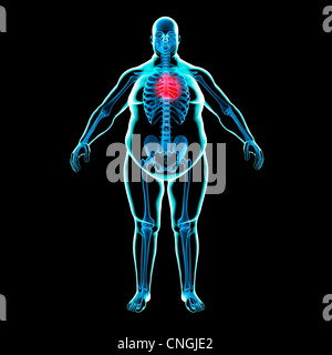 Obese man's heart  artwork Stock Photo