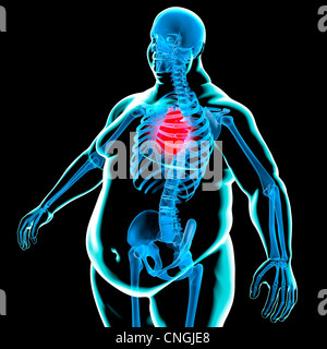 Obese man's heart  artwork Stock Photo