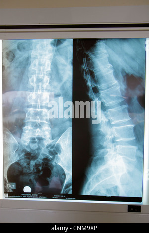 X-ray of the pelvis and spinal column Stock Photo - Alamy