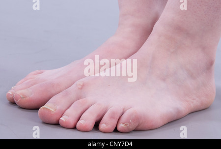 Ugly feet hi-res stock photography and images - Alamy