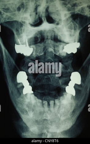 people, human beings, humans (Homo sapiens sapiens), X-ray photograph of a jawbone Stock Photo
