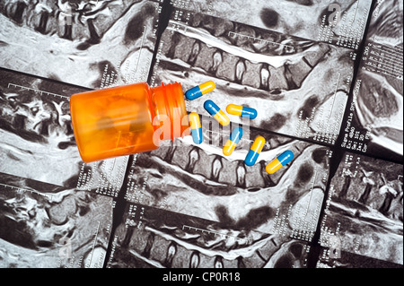 A bottle of pain medication spilled on a MRI image of a patient's spine. Stock Photo