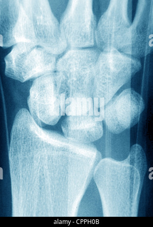 FRACTURED WRIST, X-RAY Stock Photo