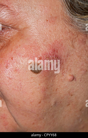 Inflamed skin rash due to a chromium-nickel allergy and seborrheic keratosis, seborrheic verruca or senile wart on the face of a Stock Photo