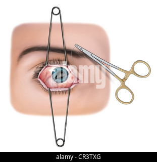 Jaffe Lid Speculum Stock Photo - Alamy