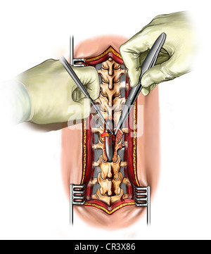 Laminectomy of T11, T12, L1 Stock Photo - Alamy