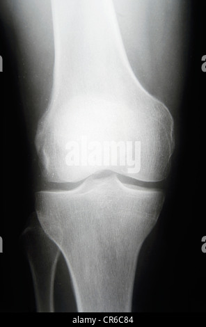 X ray of knee, close up Stock Photo - Alamy
