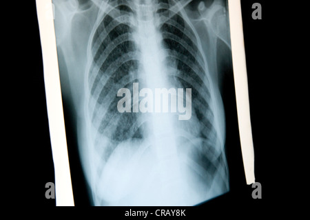 X-ray image of a lung with pulmonary tuberculosis, St. Thomas Home, Shibpur district, Howrah, Kolkata, West Bengal, India, Asia Stock Photo