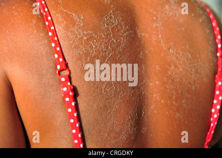 Sun damaged peeling skin on the shoulders and back of a female wearing a red bikini. Stock Photo