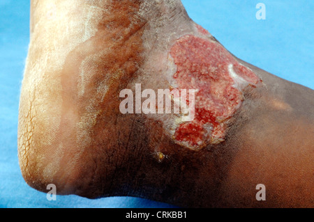 Venous ulcer on the ankle of an elderly man. An ulcer is the open sore on the skin which has failed to heal. The venous ulcer was caused by the restricted oxygen supply to the skin on the leg, caused by DVT (Deep vein thrombosis). Stock Photo