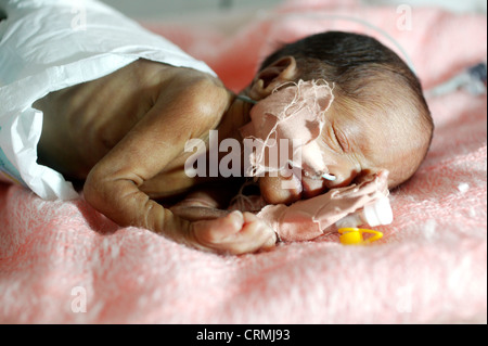 A 5 day old baby born premature at 31 weeks weighing 1kg. The baby is suffering with respiratory distress syndrome and jaundice. Stock Photo