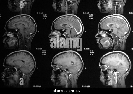 Magnetic resonance imaging (MRI) scan of skull showing myeloma. Myeloma or multiple myeloma is a type of plasma cell cancer, immune to system cells in bone marrow. Stock Photo