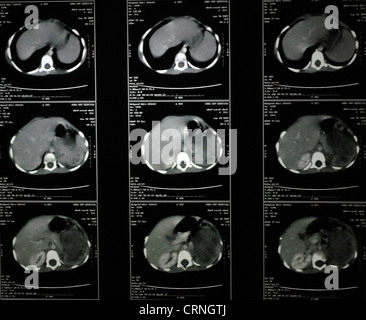 cat scan of a humans chest Stock Photo