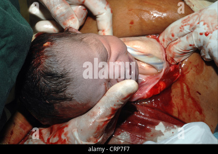 Surgeons wipe the face of the baby prior to fully removing it from the womb. Stock Photo