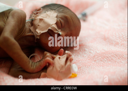 A 5 day old baby born premature at 31 weeks weighing 1kg, with respiratory distress syndrome and jaundice. Stock Photo