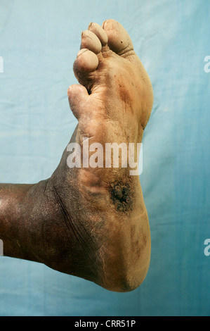 Buerger's Disease Clot Stock Photo