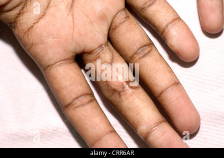 Abnormal growth on the fingers Stock Photo