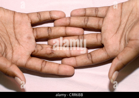 Clasped hands with abnormal growth on the fingers Stock Photo