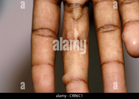 Skin abnormalities on a patients fingers Stock Photo