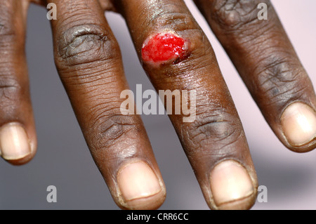 A skin growth on a finger Stock Photo