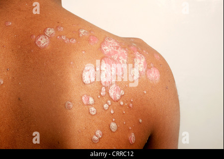 Erythroderma on the back of a young male Stock Photo