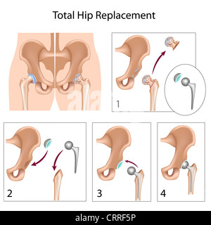 Total hip replacement surgery Stock Photo