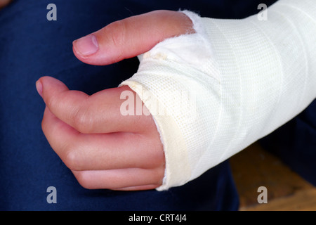 Broken hand in plaster cast with bandages, red, swollen fingers after an operation to fix the bones in place. Stock Photo