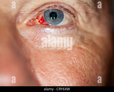 Woman's eye with broken Blood Vessel (subconjunctival hemorrhage Stock ...