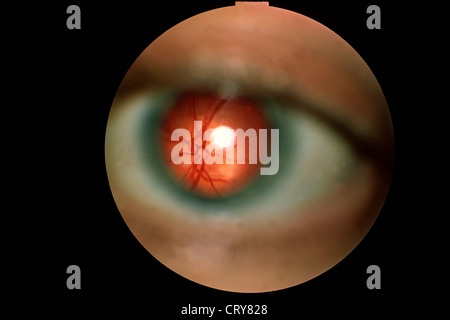 FUNDUS OCULI RESULT Stock Photo