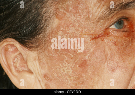 Erythema multiforme Stock Photo: 589603 - Alamy