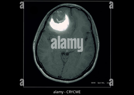 CYST IN THE BRAIN, MRI Stock Photo