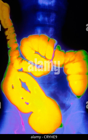 BARIUM ENEMA, X-RAY Stock Photo