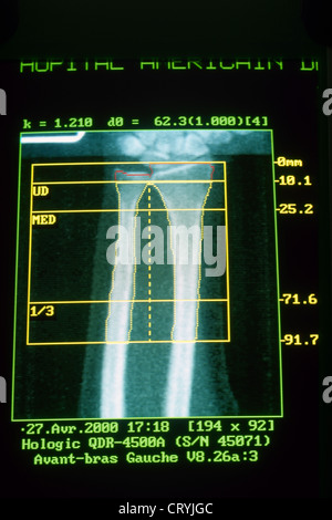 Bone Mineral Density (BMD) Testing, Or Bone Densitometry, Is A Medical ...